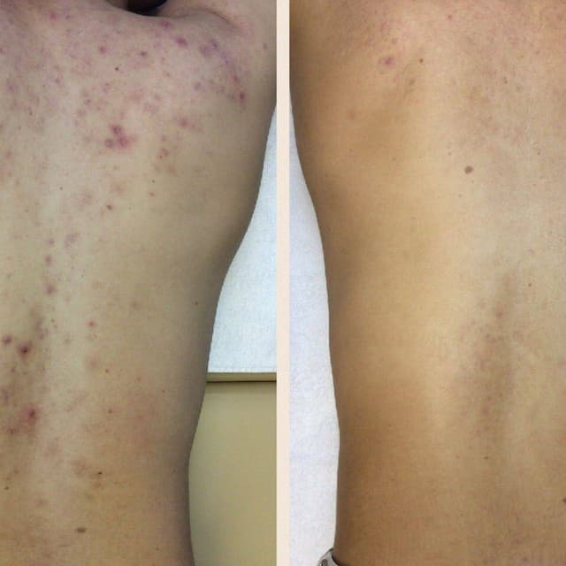 Acne Removal Back